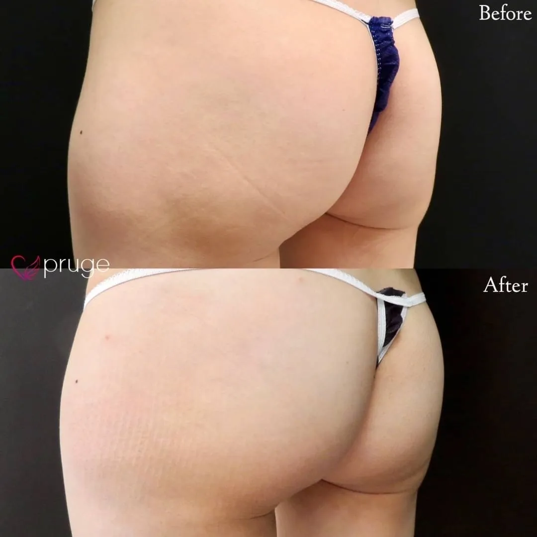 PRP注射によるヒップ形成