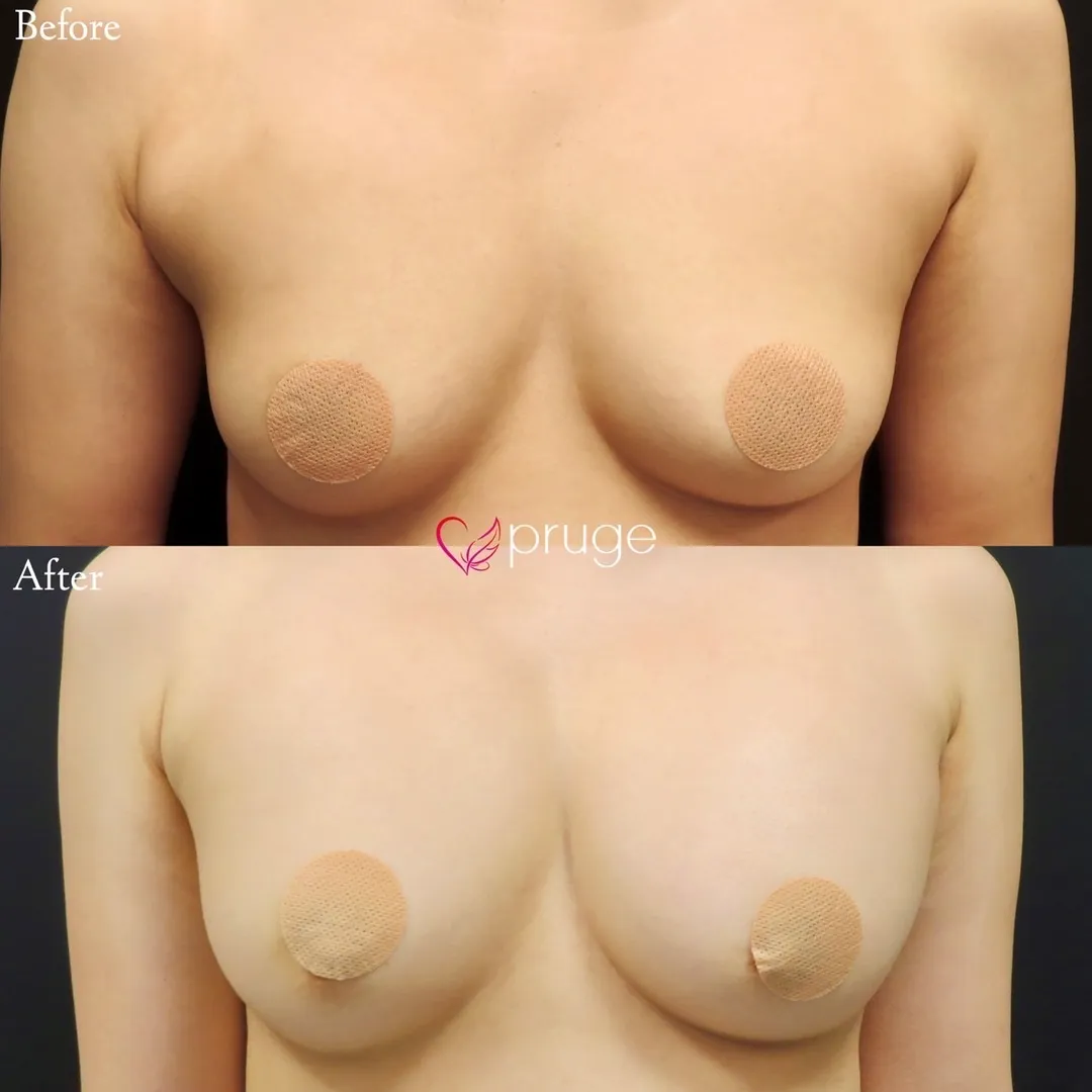 PRP注射によるバストアップ