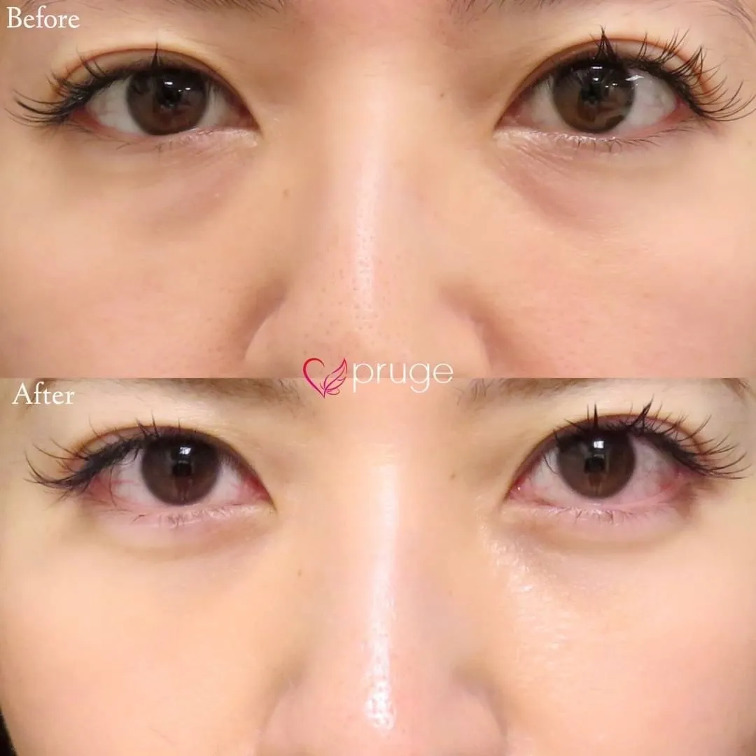 PRP-MI脱脂術（目の下）