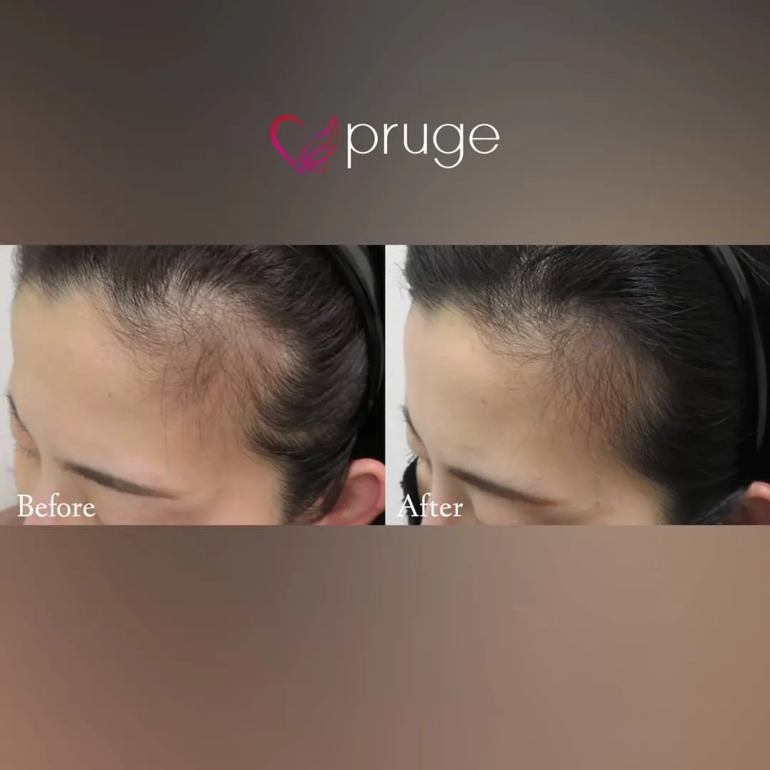 ｐ-スカルプ（3回）