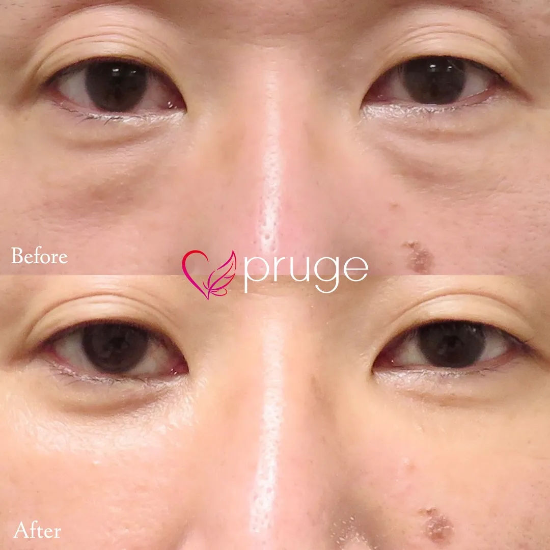 目の下のクマ・ふくらみ