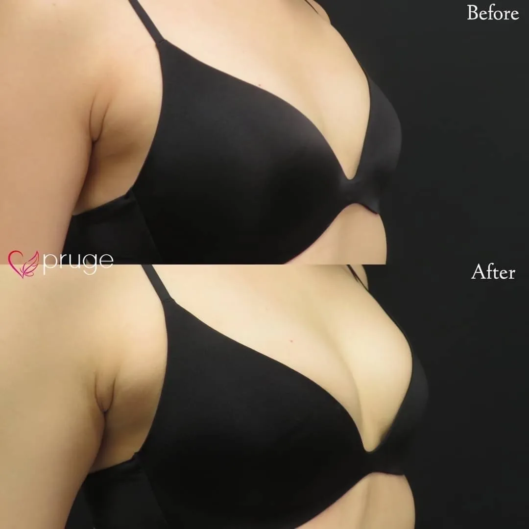 PRP注射（お胸）