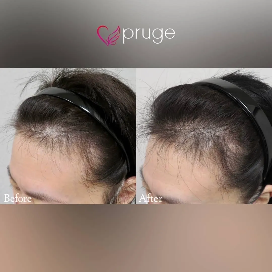 ｐ-スカルプ（3回）