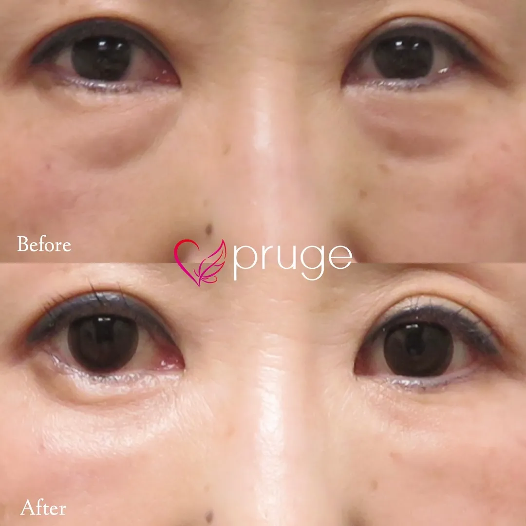 目の下のクマ・ふくらみ