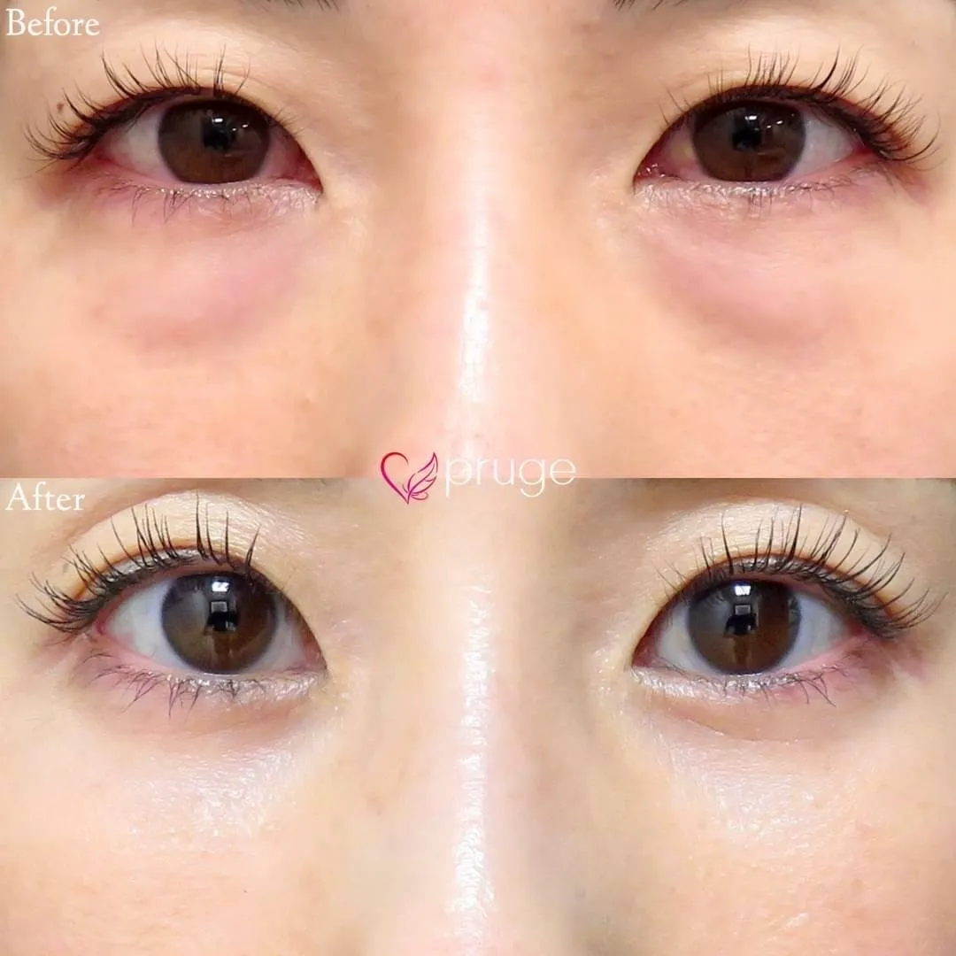 PRP-MI脱脂術（目の下）