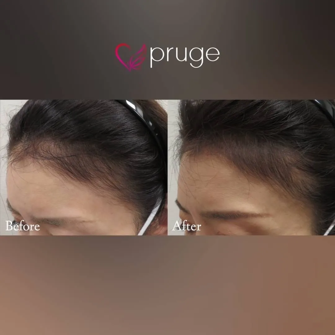 p-スカルプ（2回）