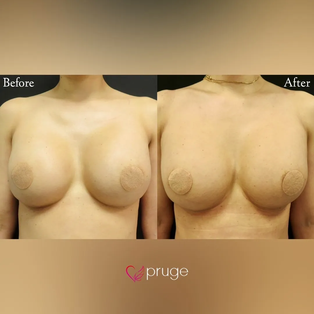 PRP注射によるシリコンバッグ豊胸修正