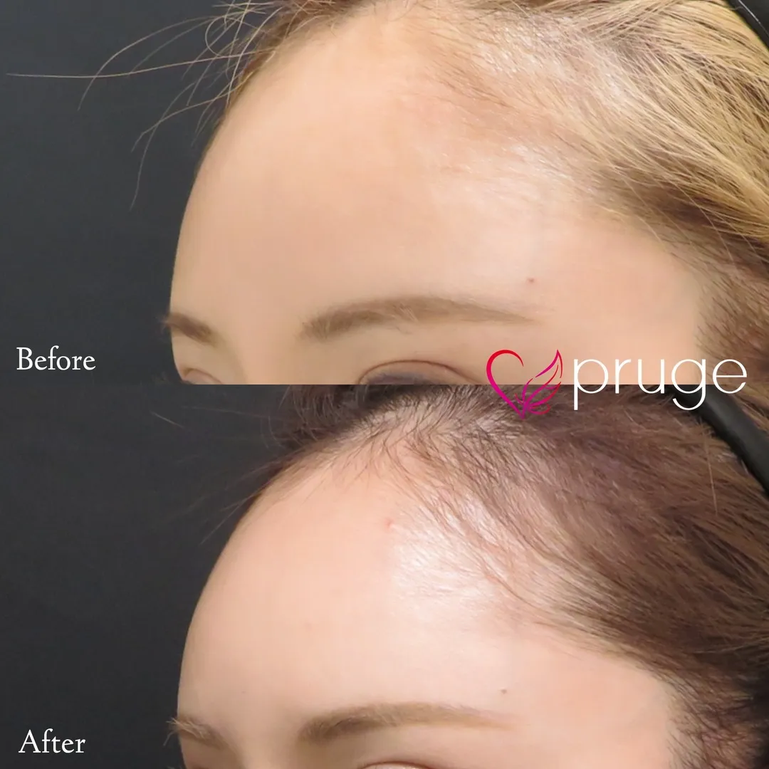 額の傾斜・凹み