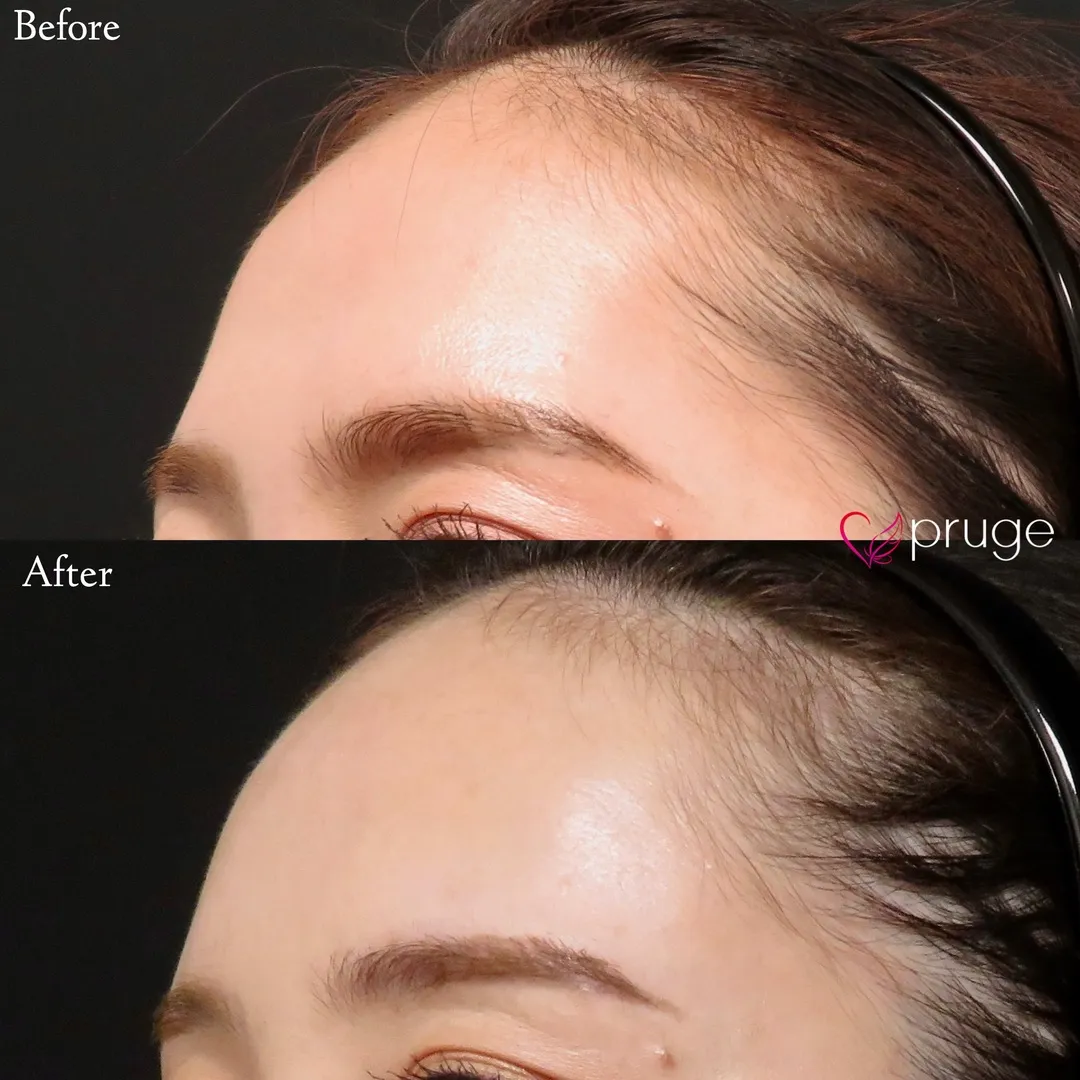 PRP注射(ひたい・こめかみ丸み形成)