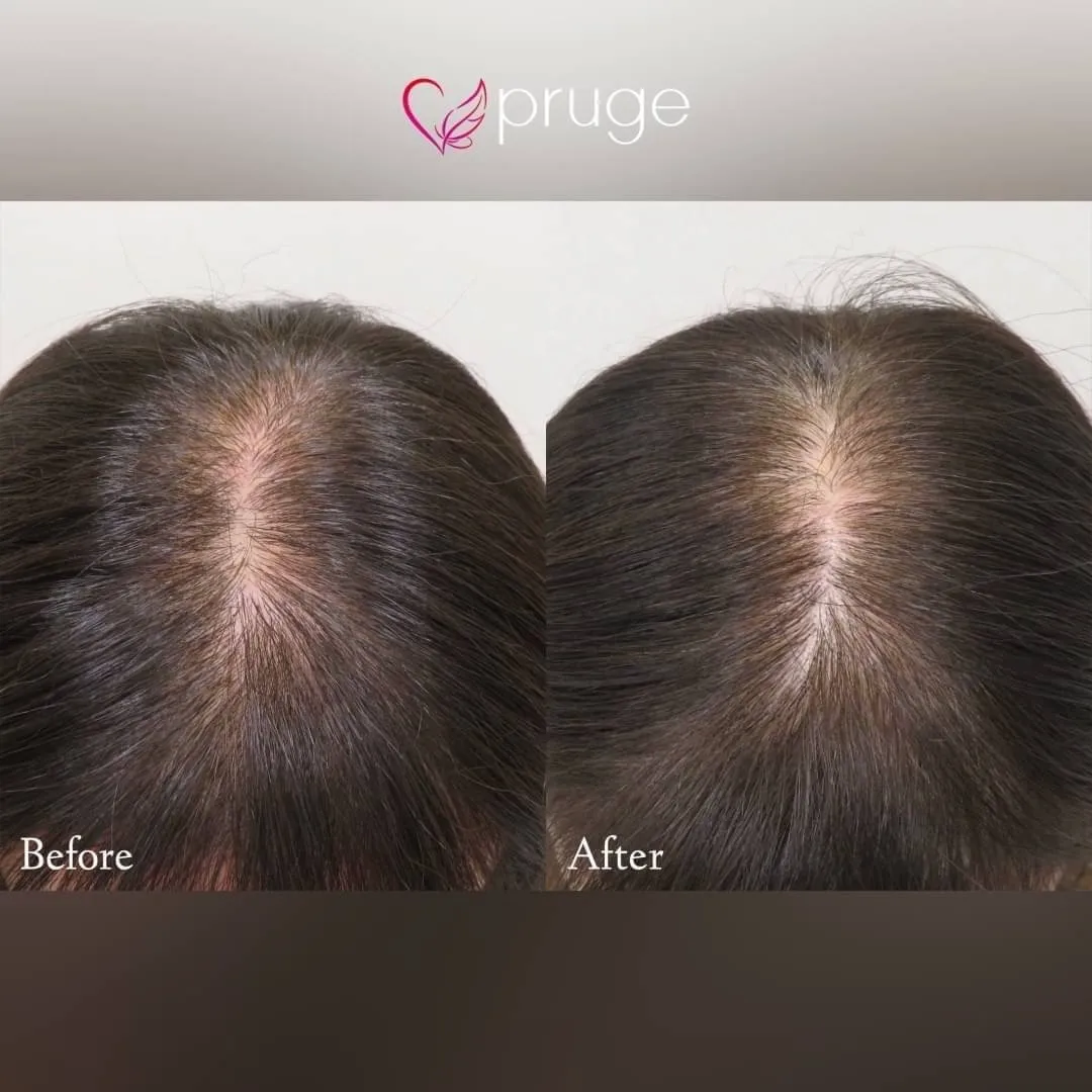 ｐ-スカルプ（1回）