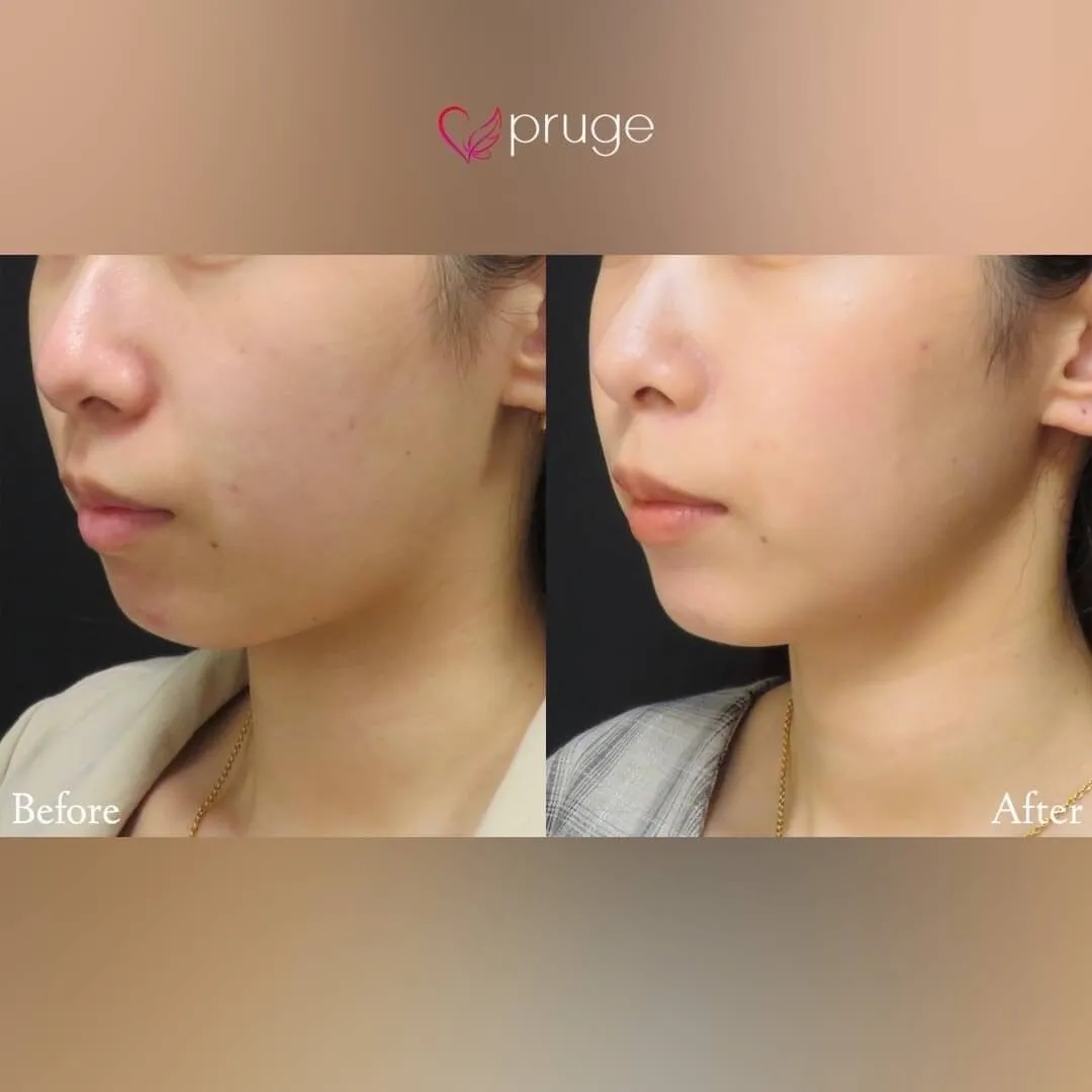 pスリム注射（フェイスライン）