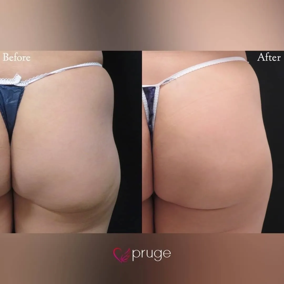 PRP注射によるヒップ形成