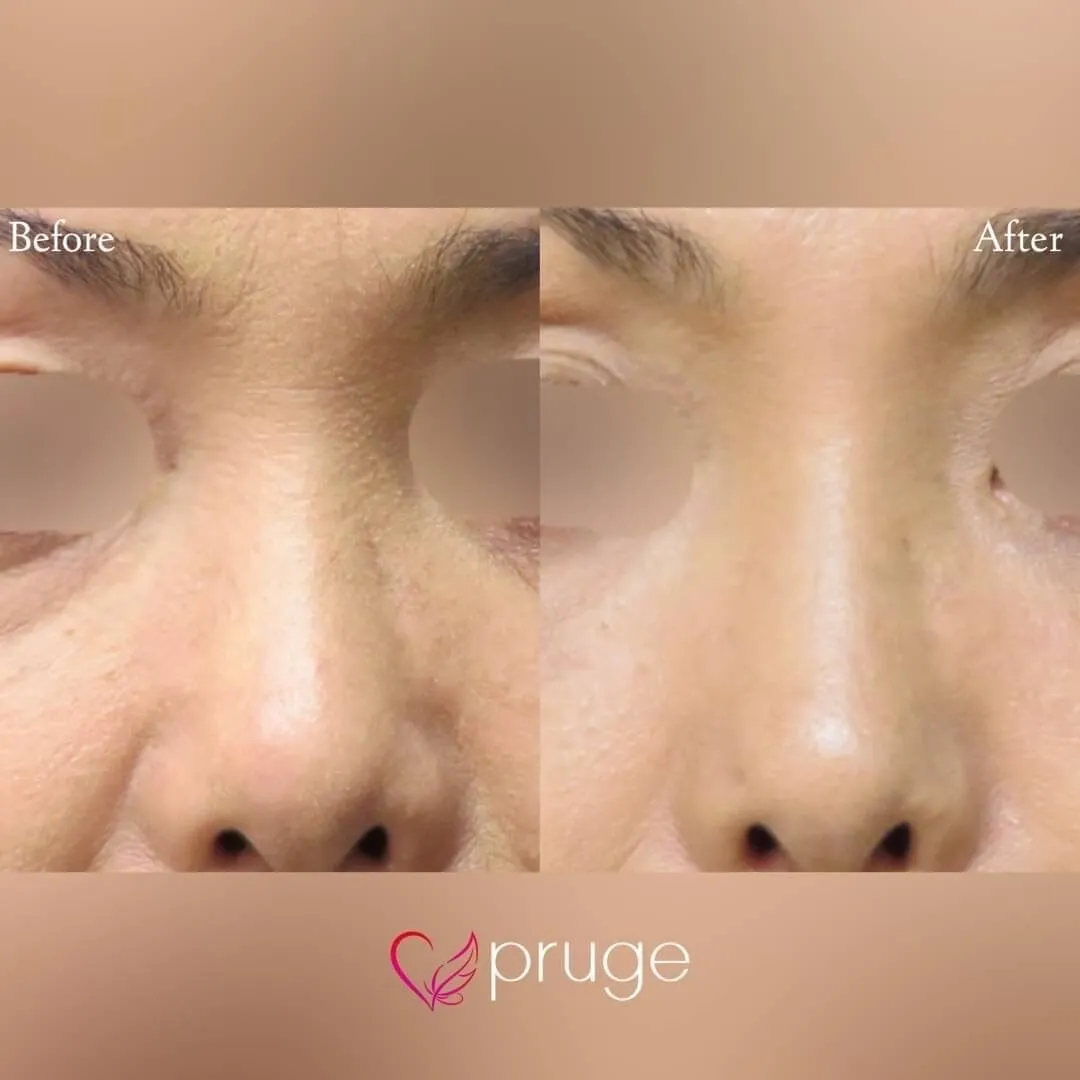 PRP注射（鼻根）