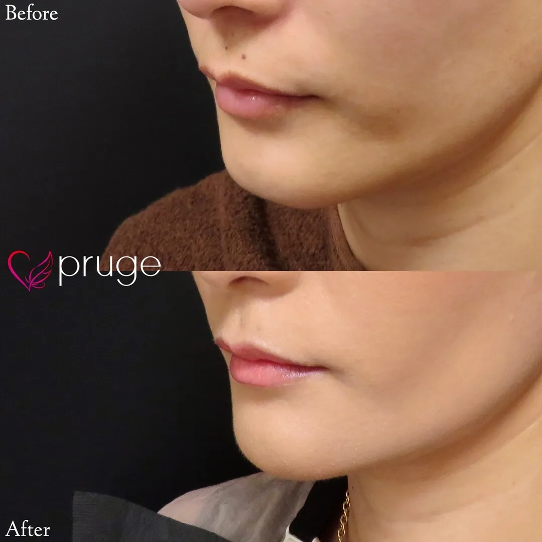 PRP注射（アゴ）