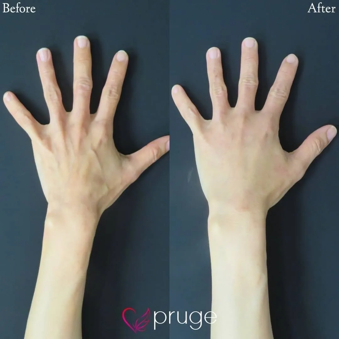 PRP注射（手の甲）