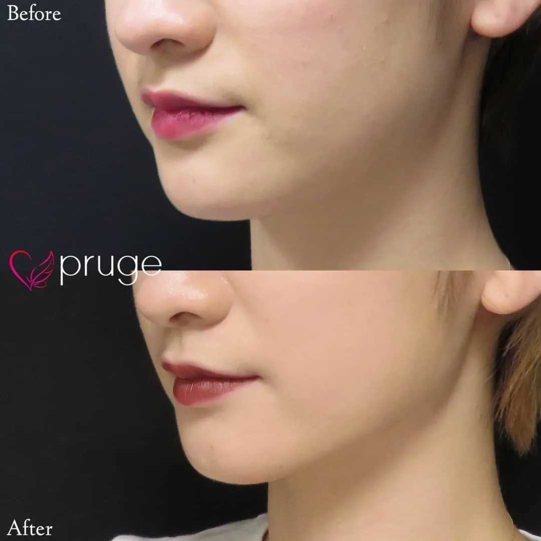 ｐスリム注射（フェイスライン）