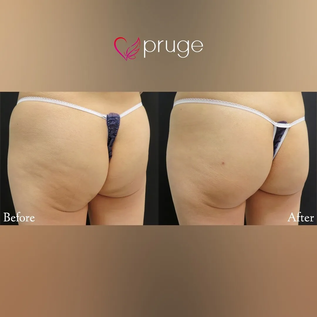 PRP注射によるヒップ形成