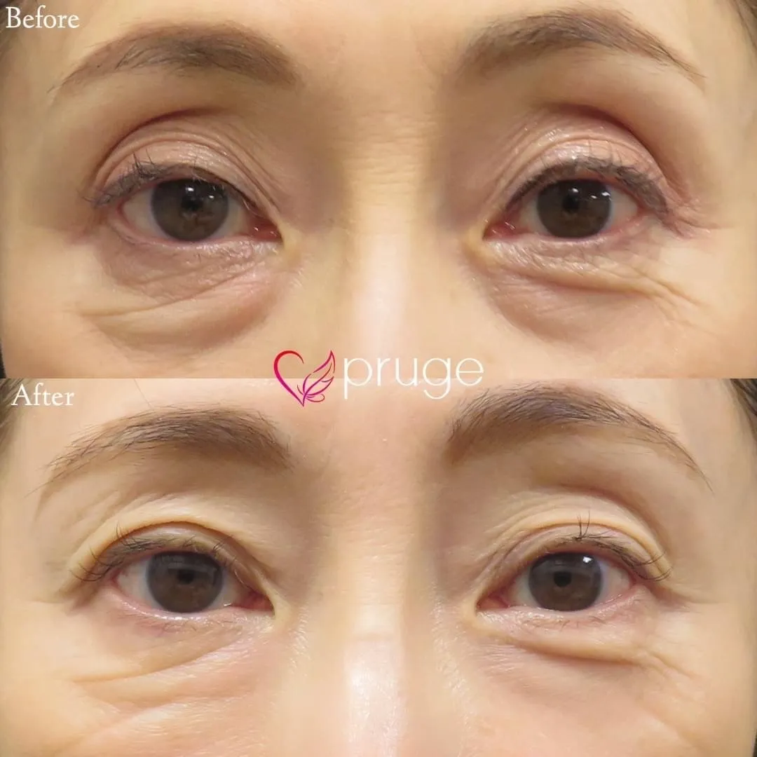 PRP注射（目の上・目の下）