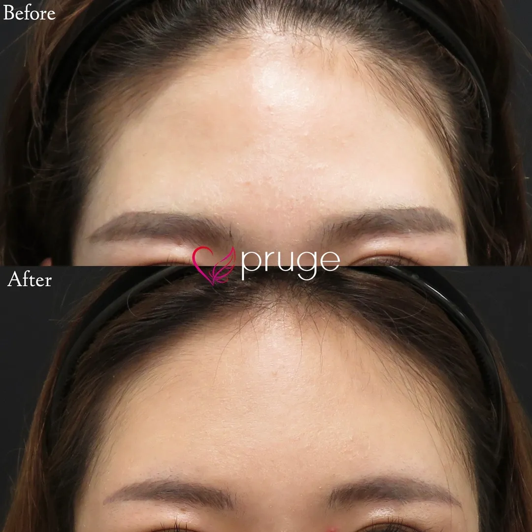 PRP注射(ひたい・こめかみ丸み形成)