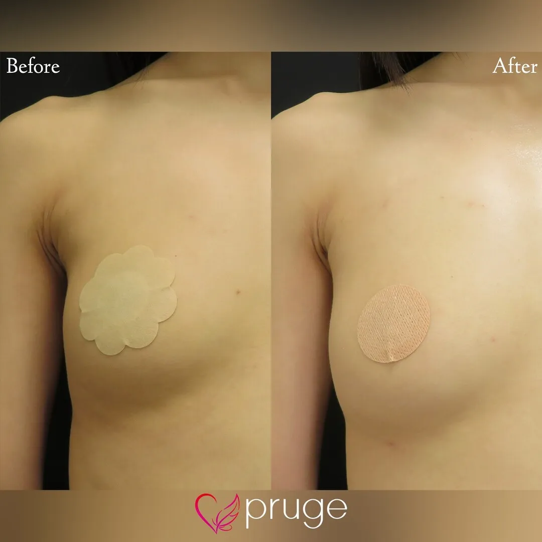 PRP注射によるシリコンバッグ豊胸修正