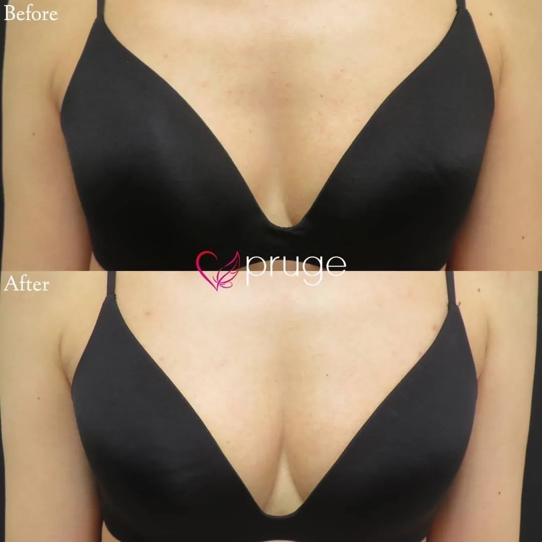 PRP注射（お胸）