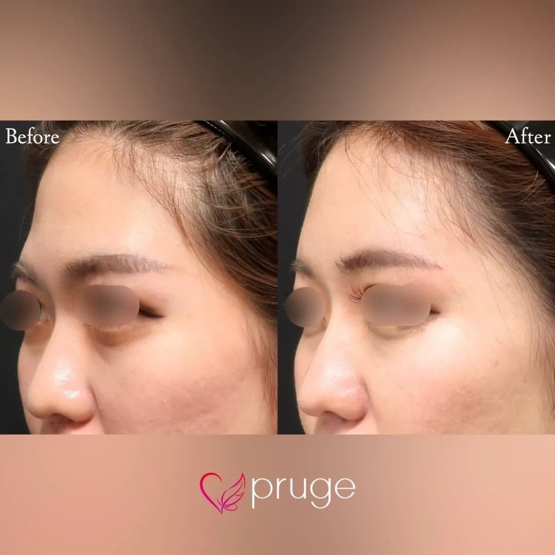 PRP注射（ひたい・こめかみ・鼻根・鼻尖）