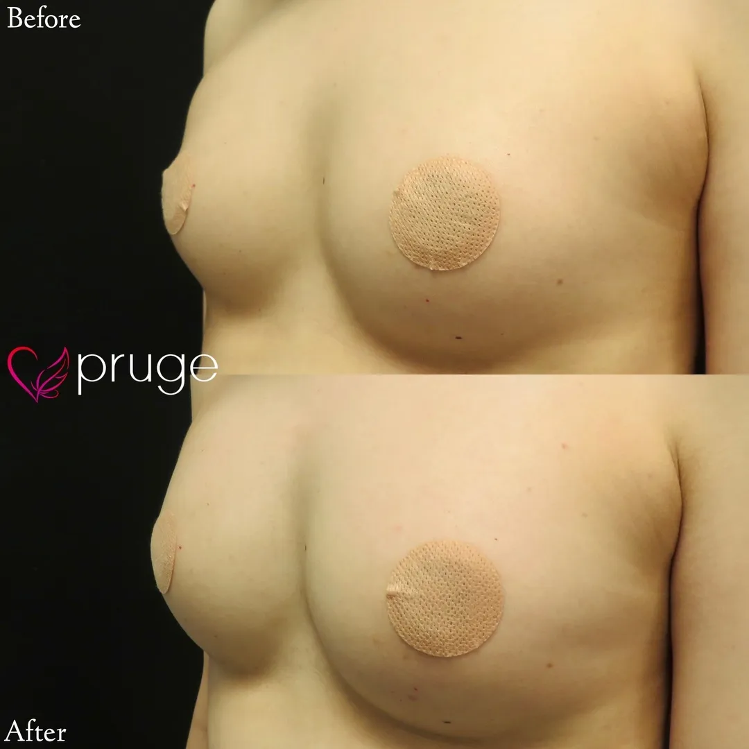 PRP注射によるバストアップ