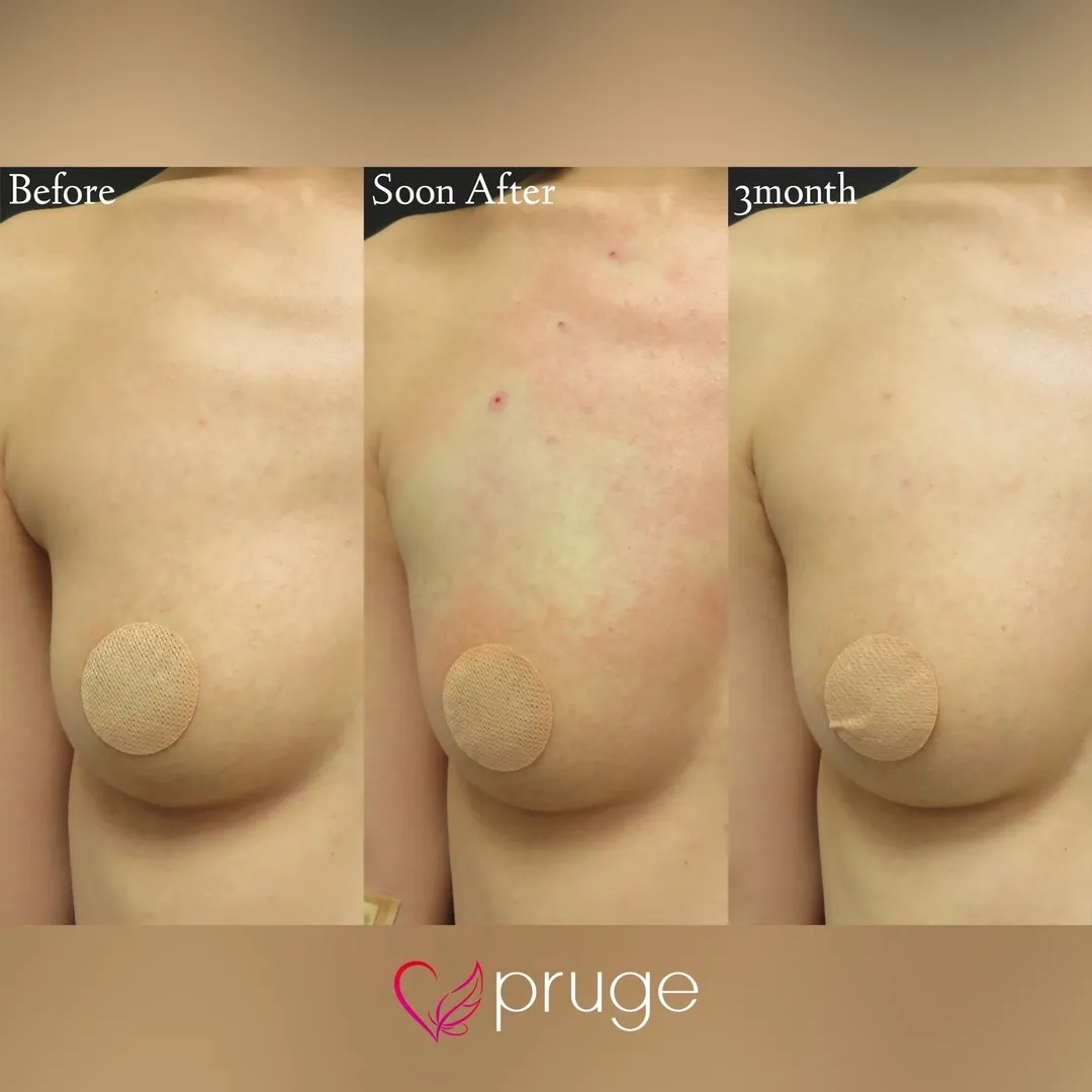 PRP注射によるバストアップ