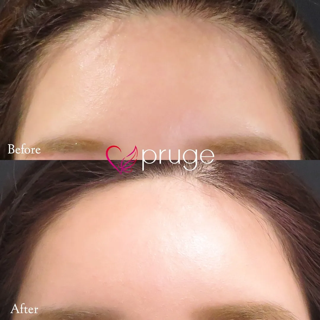 額・こめかみの凹み