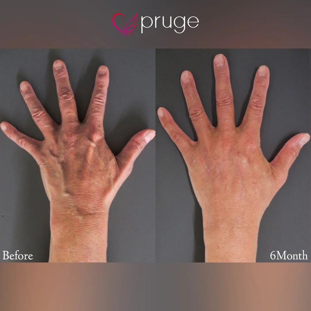 PRP注射（手の甲）・ハンドベイン