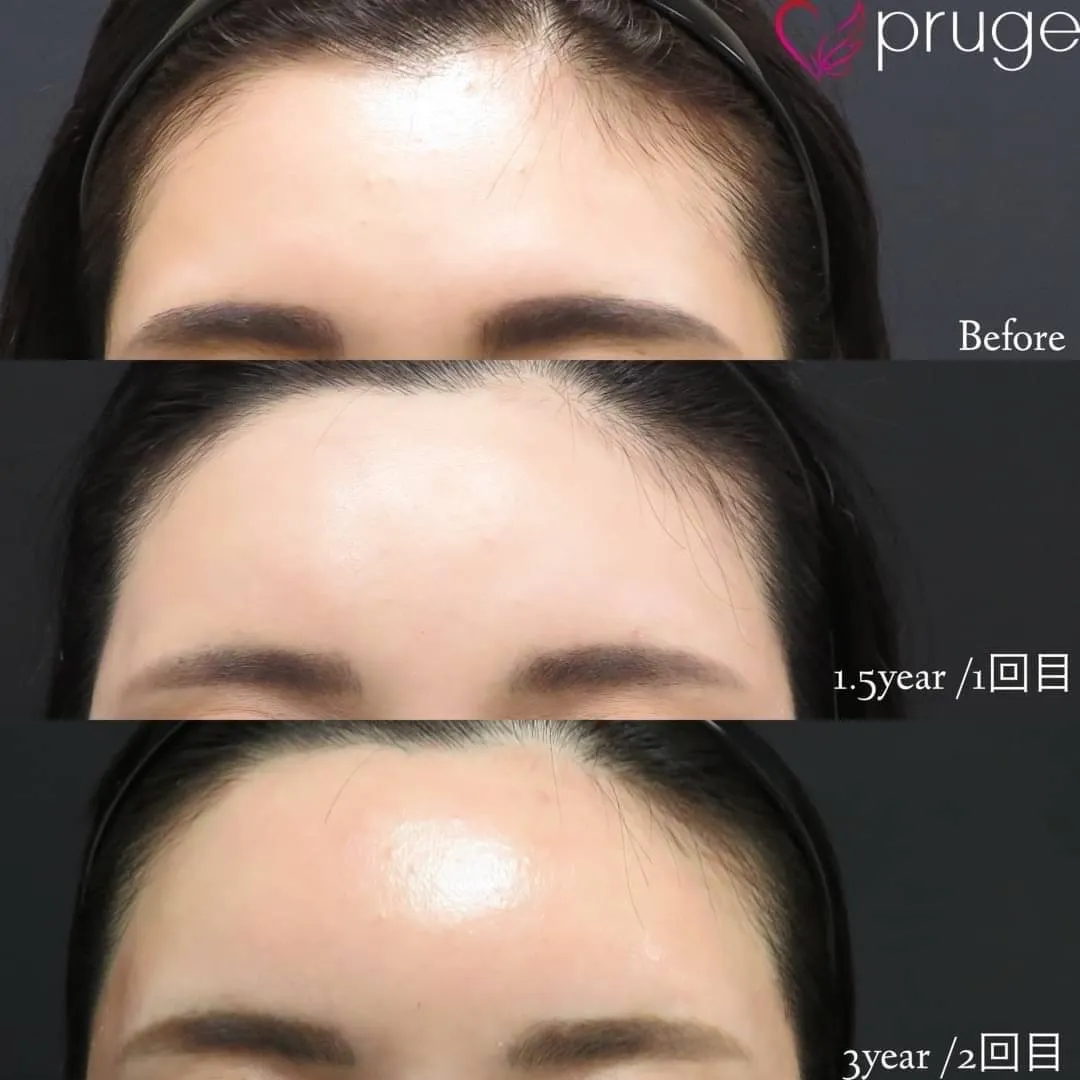 PRP注射(ひたい・こめかみ丸み形成)