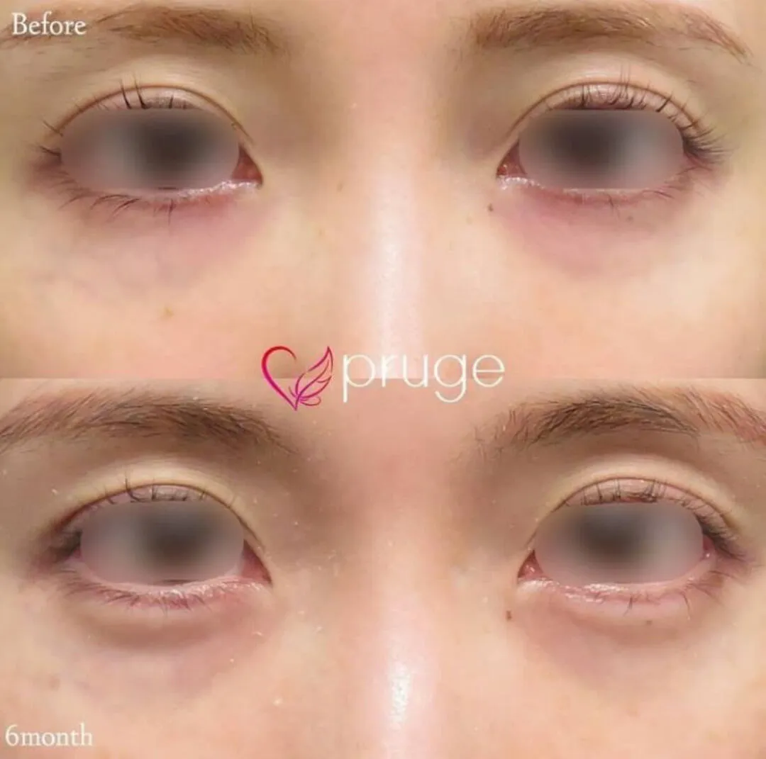 PRP注射（涙袋）