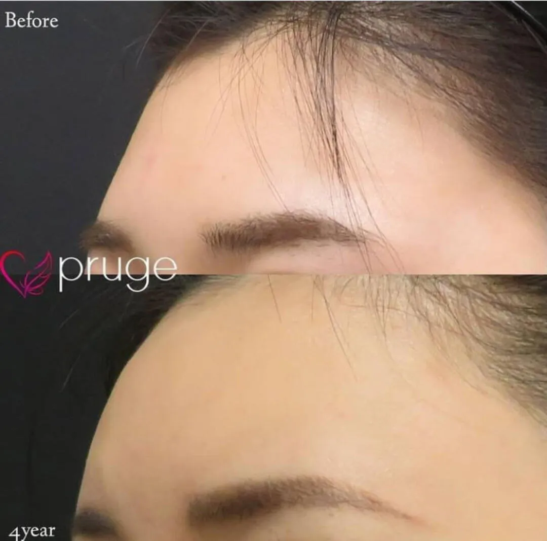 PRP注射(ひたい・こめかみ丸み形成)