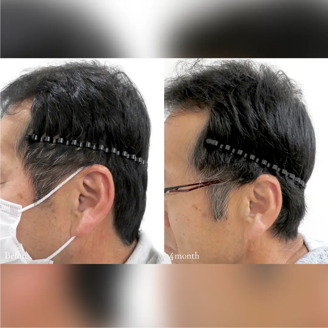 PRP注射による後頭部形成術