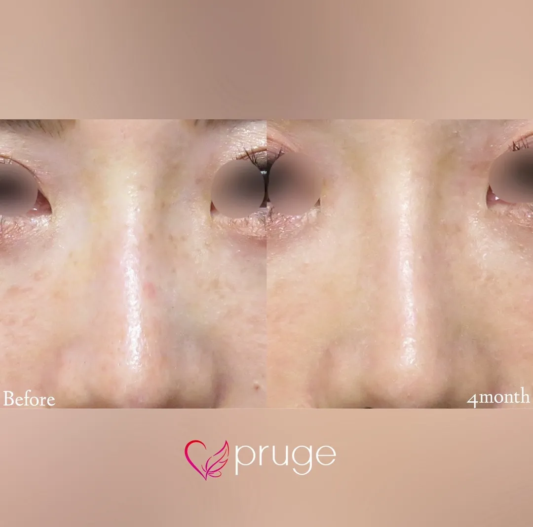 PRP注射（鼻根）