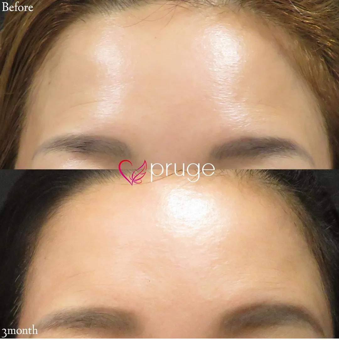 PRP注射(額シワ)