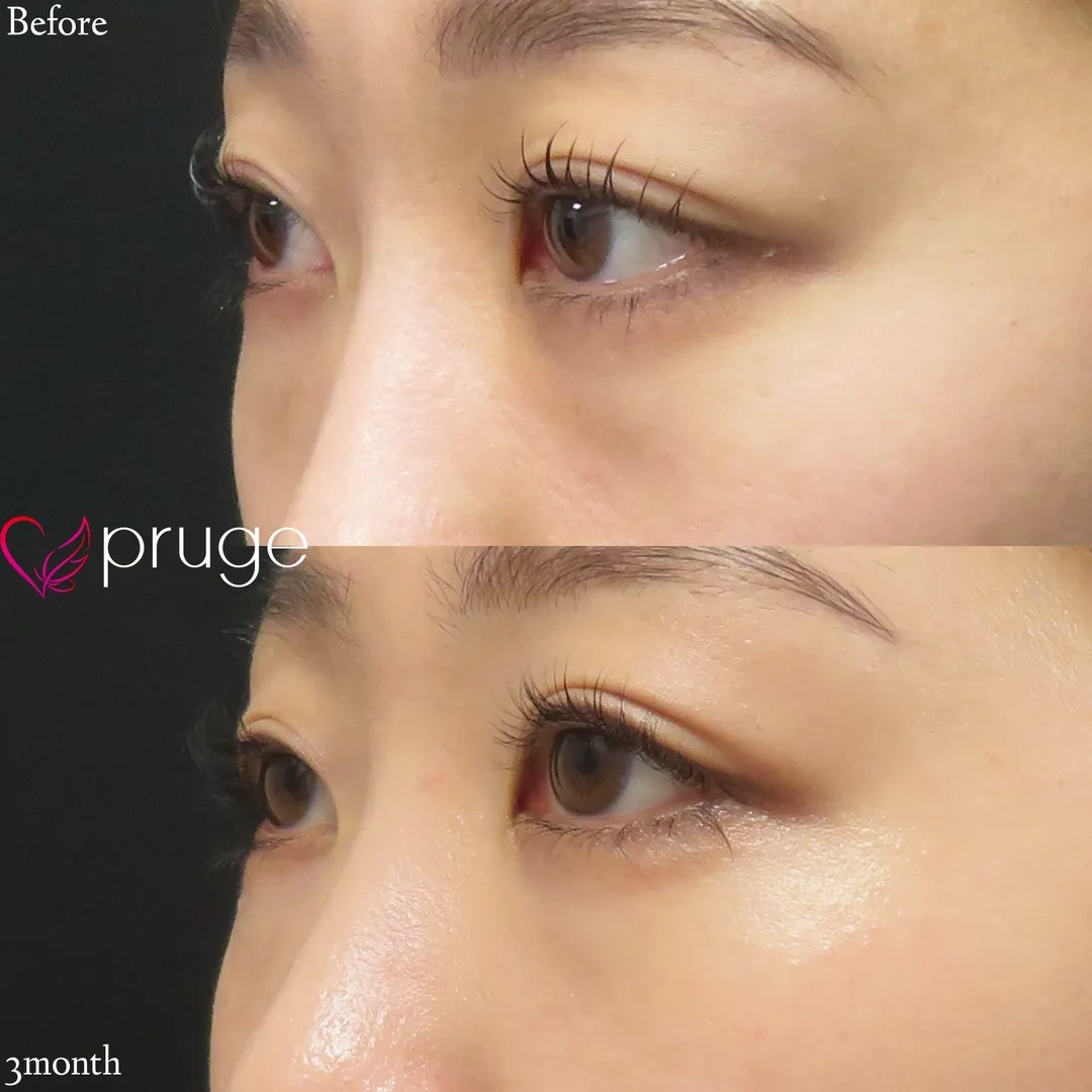 PRP注射（目の下・ゴルゴライン）