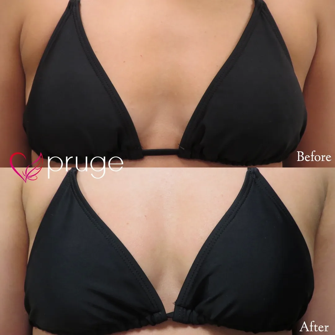 PRP注射（お胸）