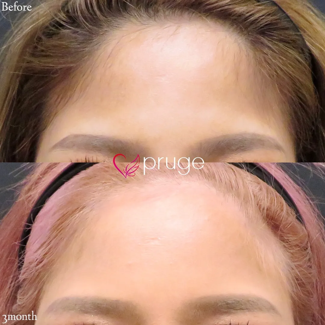 PRP注射(ひたい・こめかみ丸み形成)