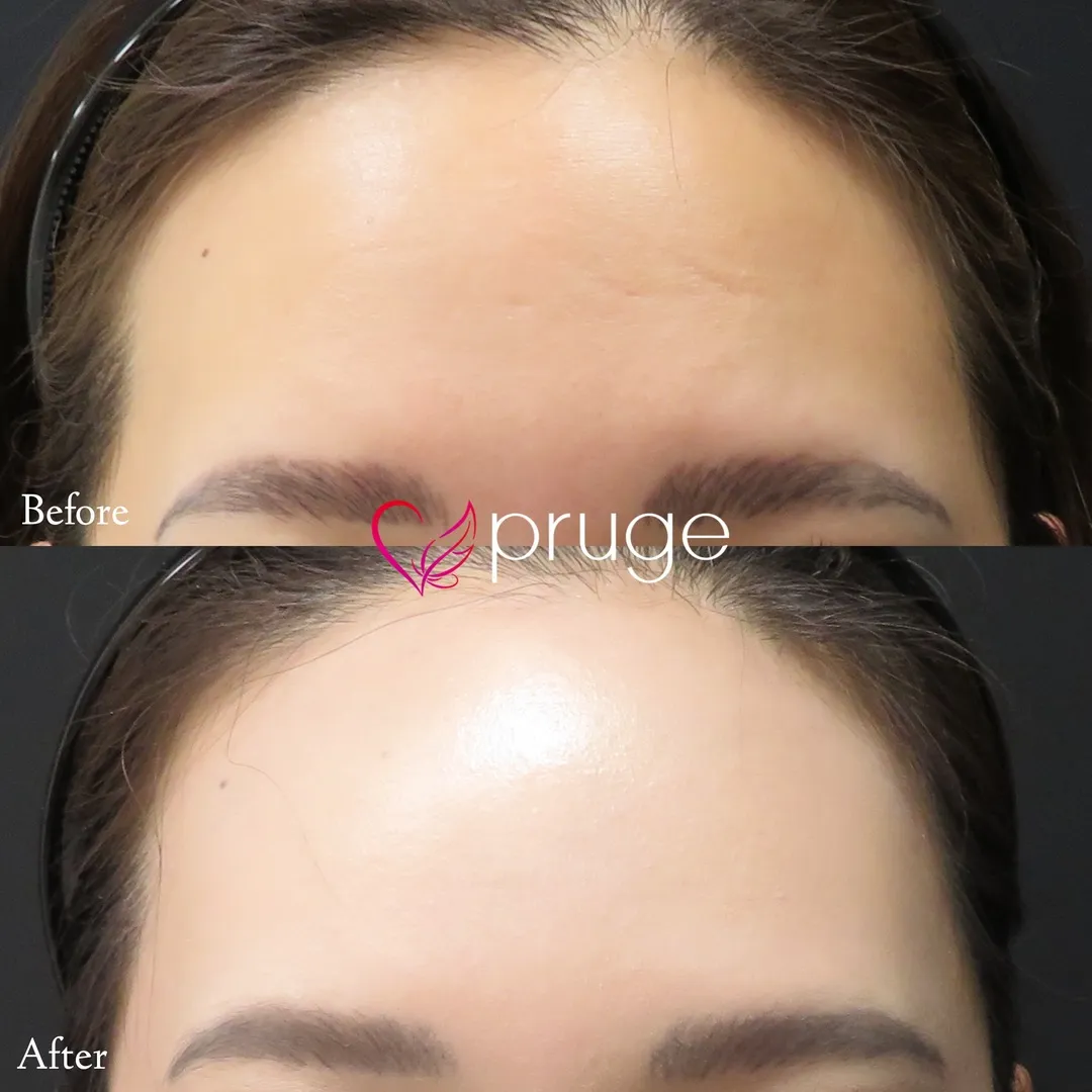 額の傾斜・凹み