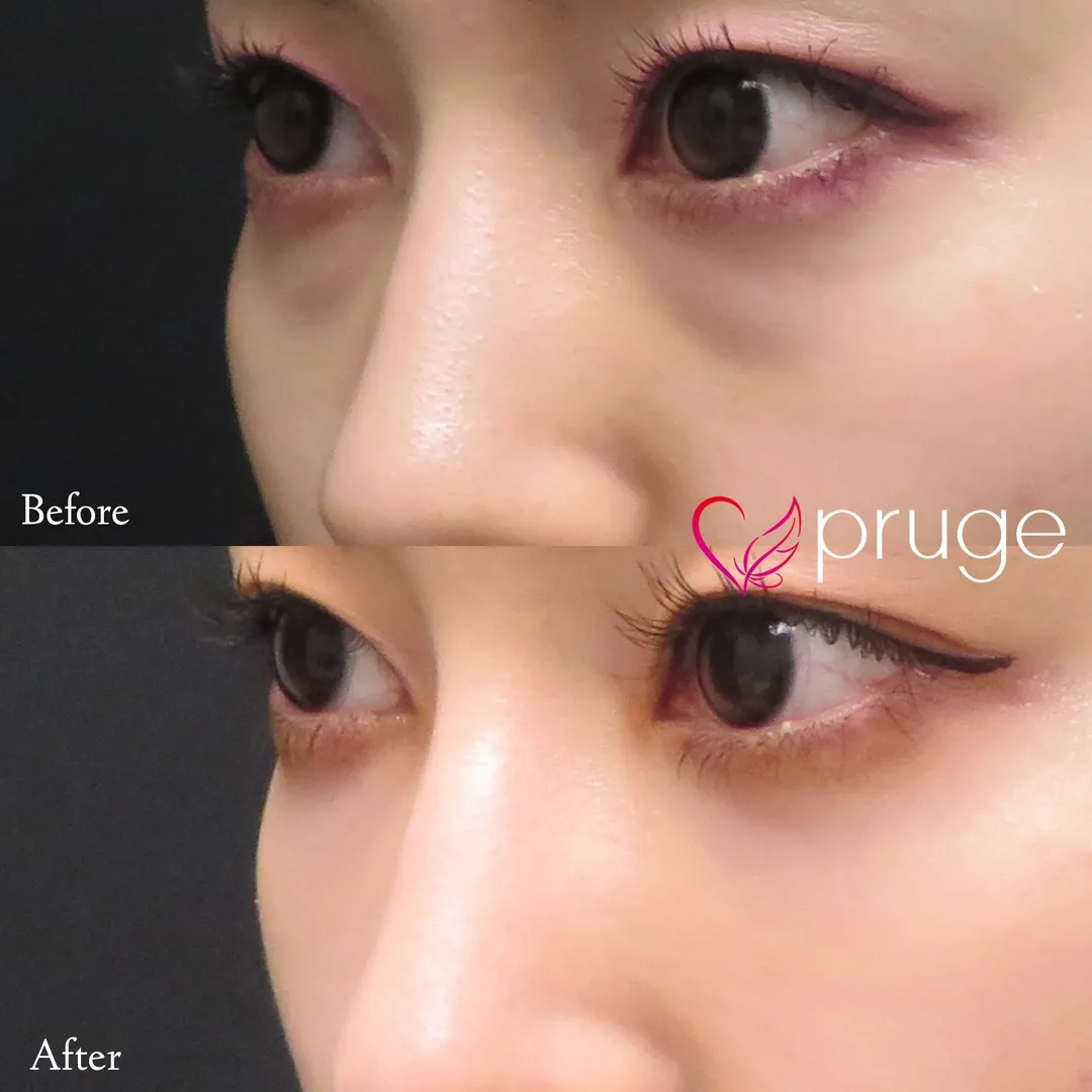 目の下のクマ・凹み