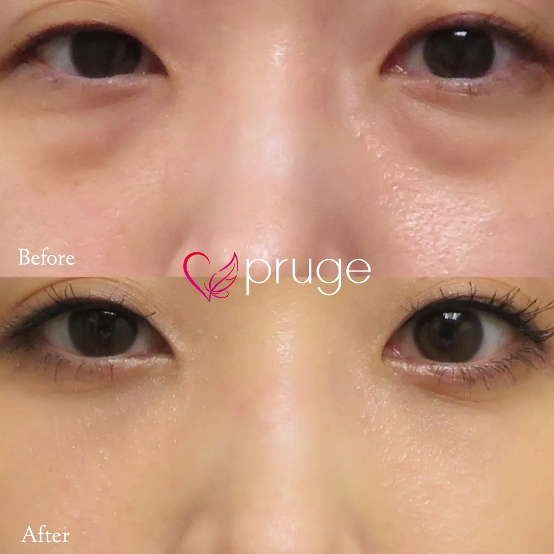 目の下のクマ・ふくらみ