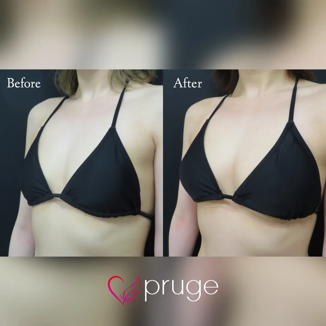 PRP注射（お胸）