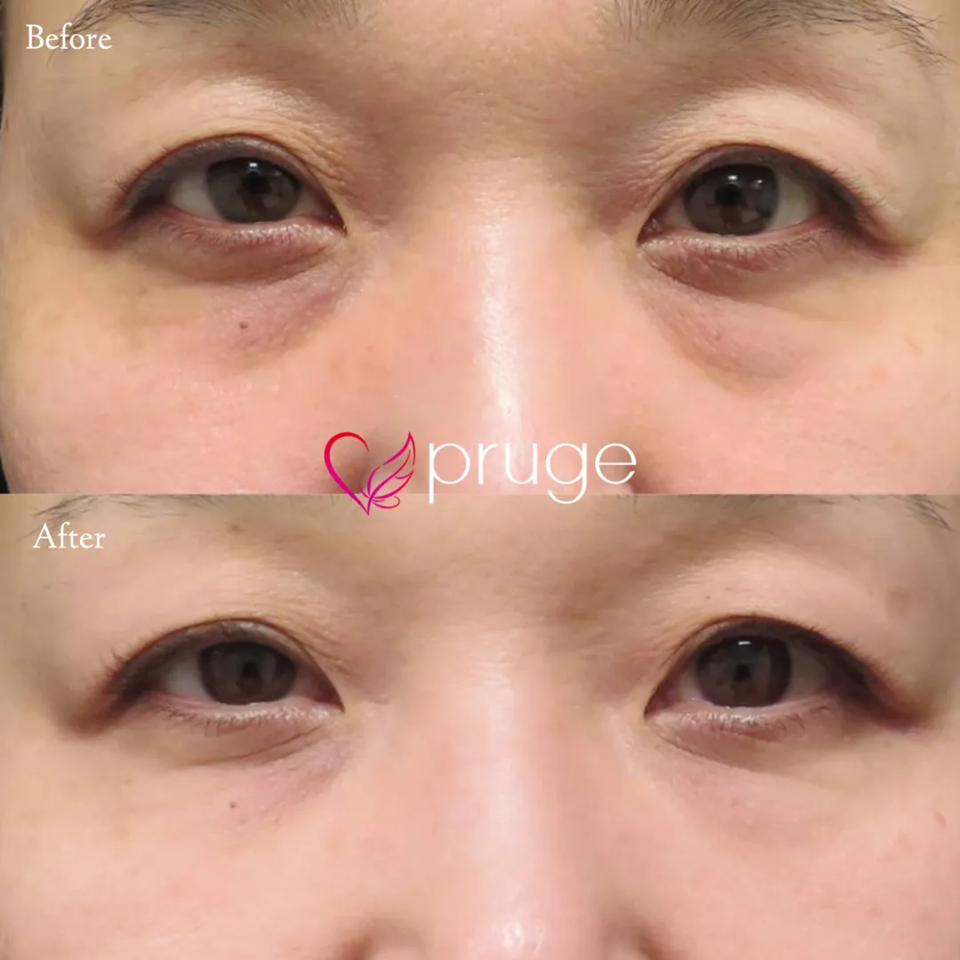 目の下のクマ・上まぶたの凹み