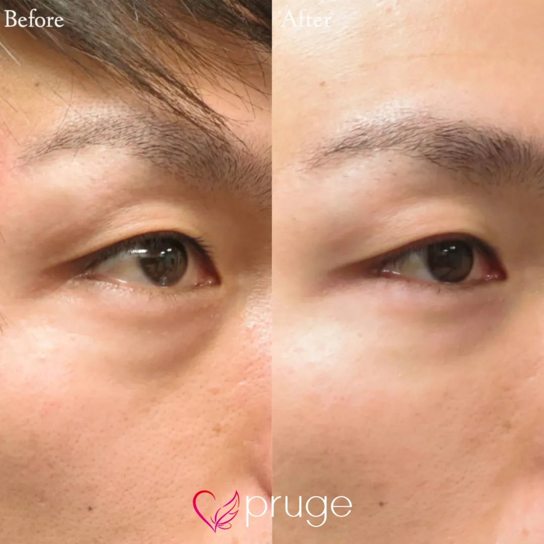 目の下のクマ・膨らみ