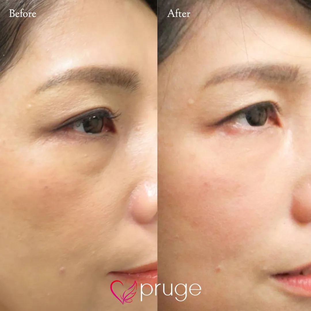 目の下のクマ・ゴルゴライン