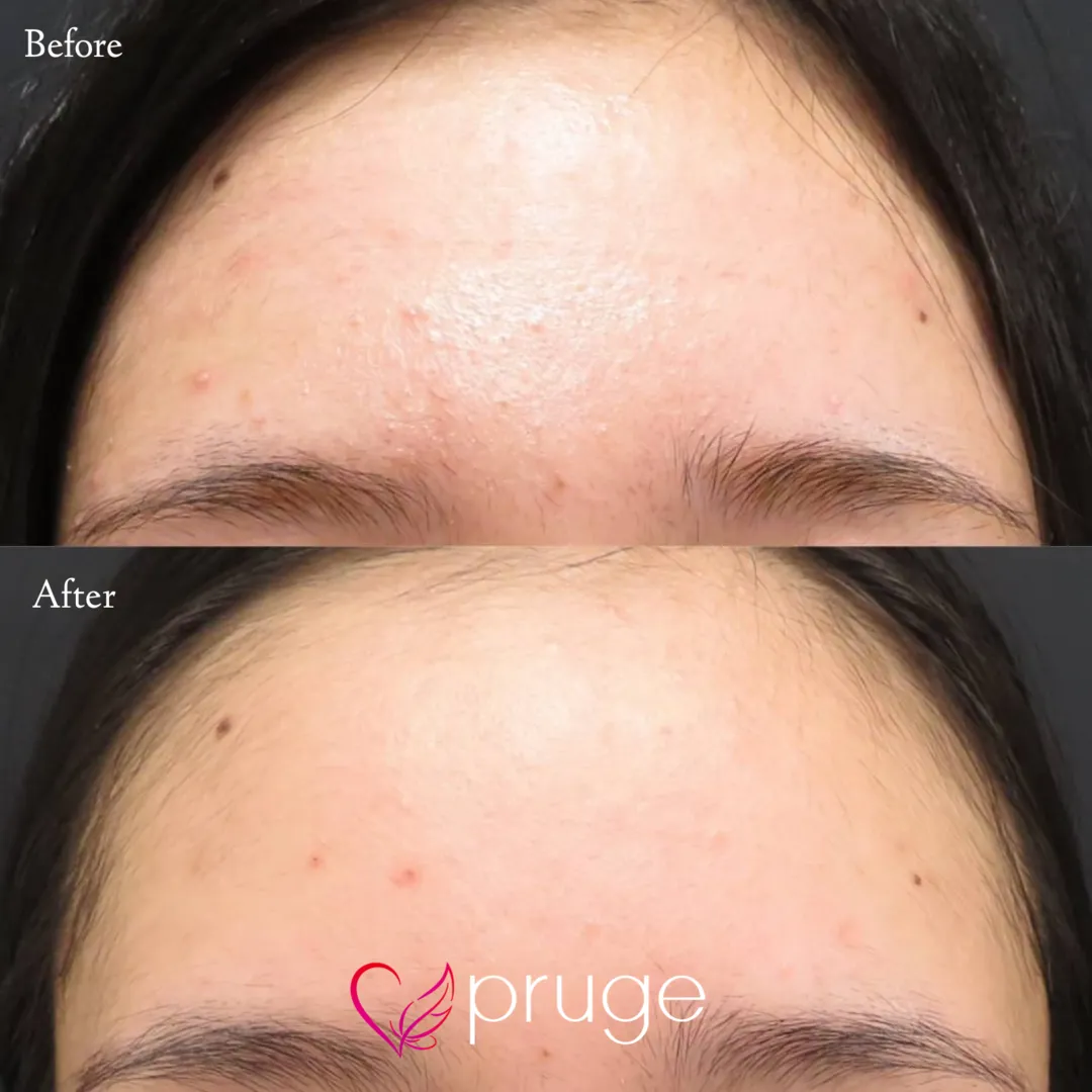 ヴァンパイアフェイシャル（額）