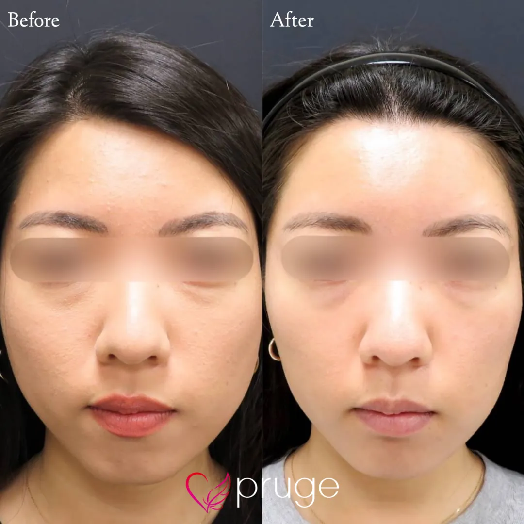 ヴァンパイアフェイシャル（全顔）