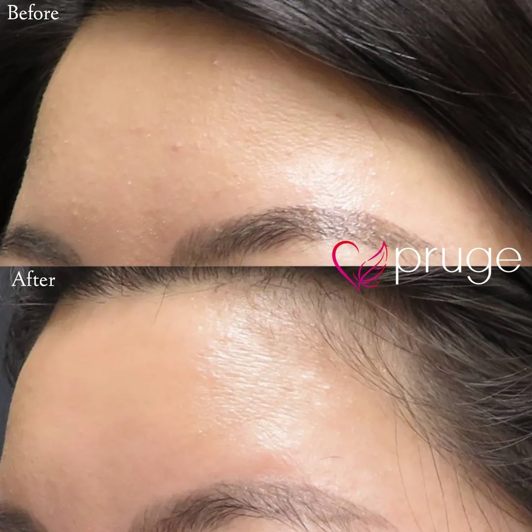 ヴァンパイアフェイシャル（額）