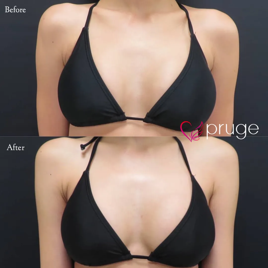 PRP注射（お胸）